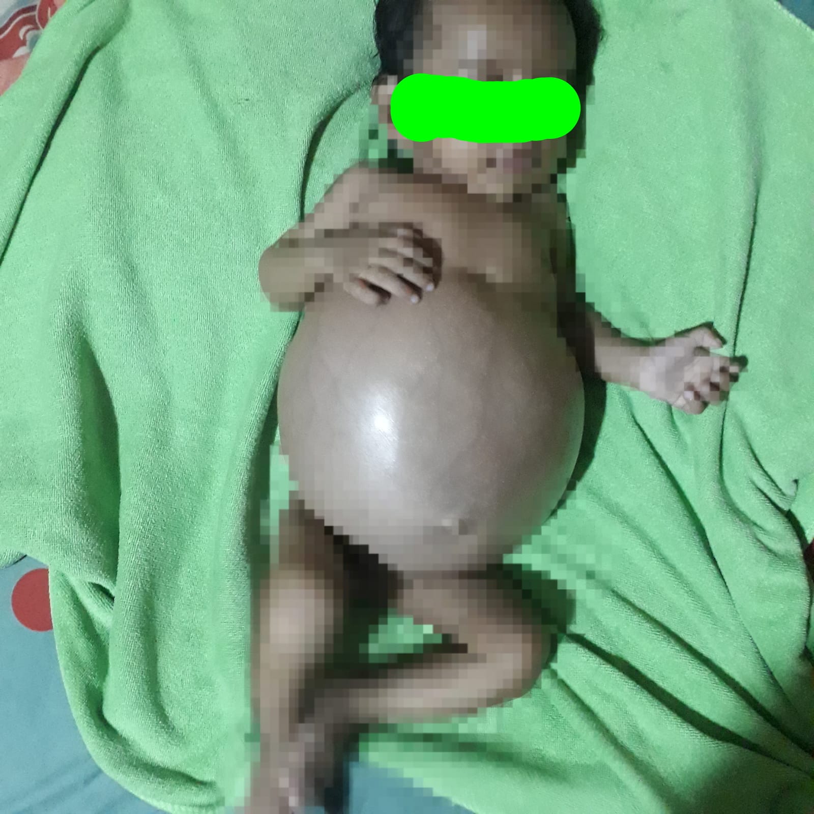 Bayi pengidap kanker langka Neuroblastoma stadium 3, di kabupaten Agam, Sumbar. Foto ist.